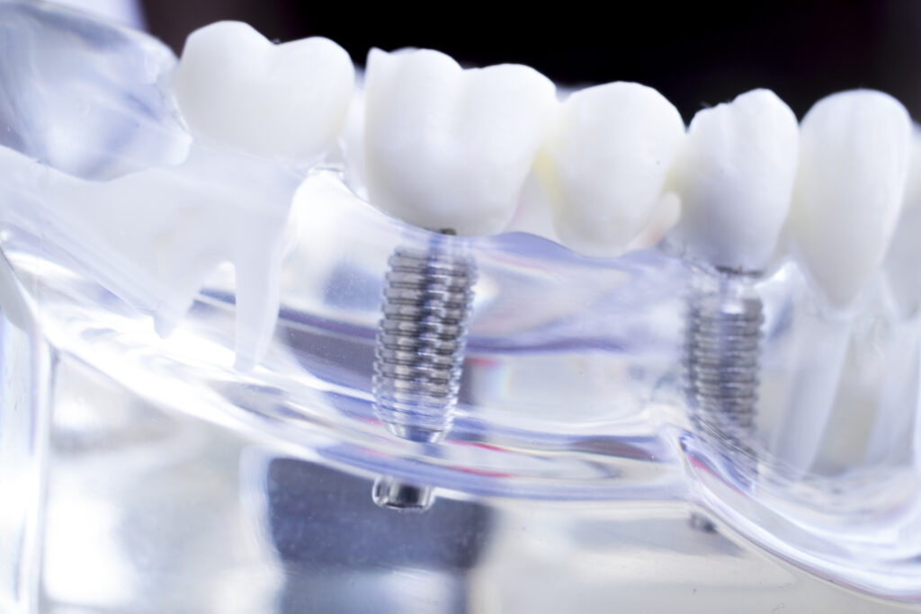 Darstellung von Implantaten mit darauf befestigten Zahnkronen als moderner Zahnersatz